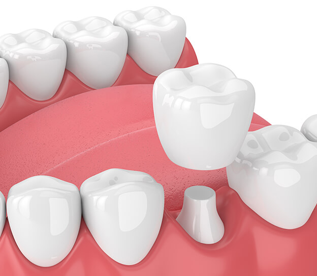 illustration of a dental crown