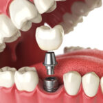 A dental implant surgically inserted into the gums as a permanent tooth replacement solution