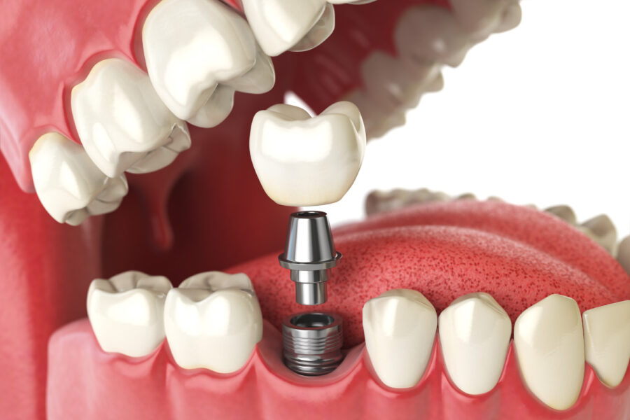 A dental implant surgically inserted into the gums as a permanent tooth replacement solution