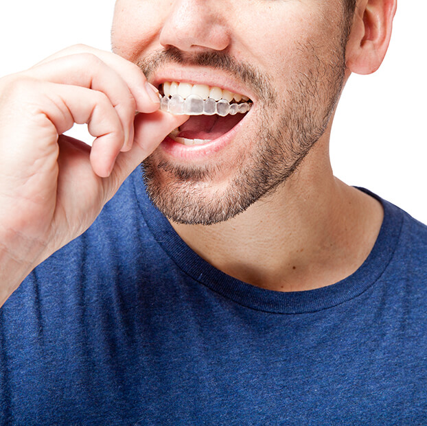 man inserting his clear aligners onto his teeth