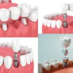4 image collage showing a traditional dental bridge, an implant-supported bridge, and 2 different dental implants