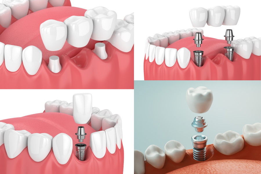 4 image collage showing a traditional dental bridge, an implant-supported bridge, and 2 different dental implants