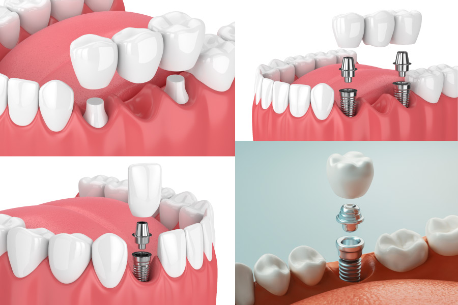 dental bridges vs implants