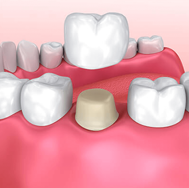 illustration of a dental crown