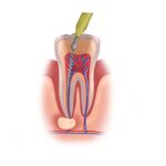 root canal, dental health, Mauka Family Dental, Mililani HI, tooth pain, swollen gums, tooth sensitivity, bad breath, dental infection