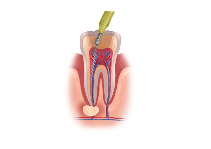 root canal, dental health, Mauka Family Dental, Mililani HI, tooth pain, swollen gums, tooth sensitivity, bad breath, dental infection