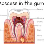 abscessed tooth, tooth pain, dentist in Mililani, root canal therapy, tooth extraction, dental infection, Mauka Family Dental, gum abscess