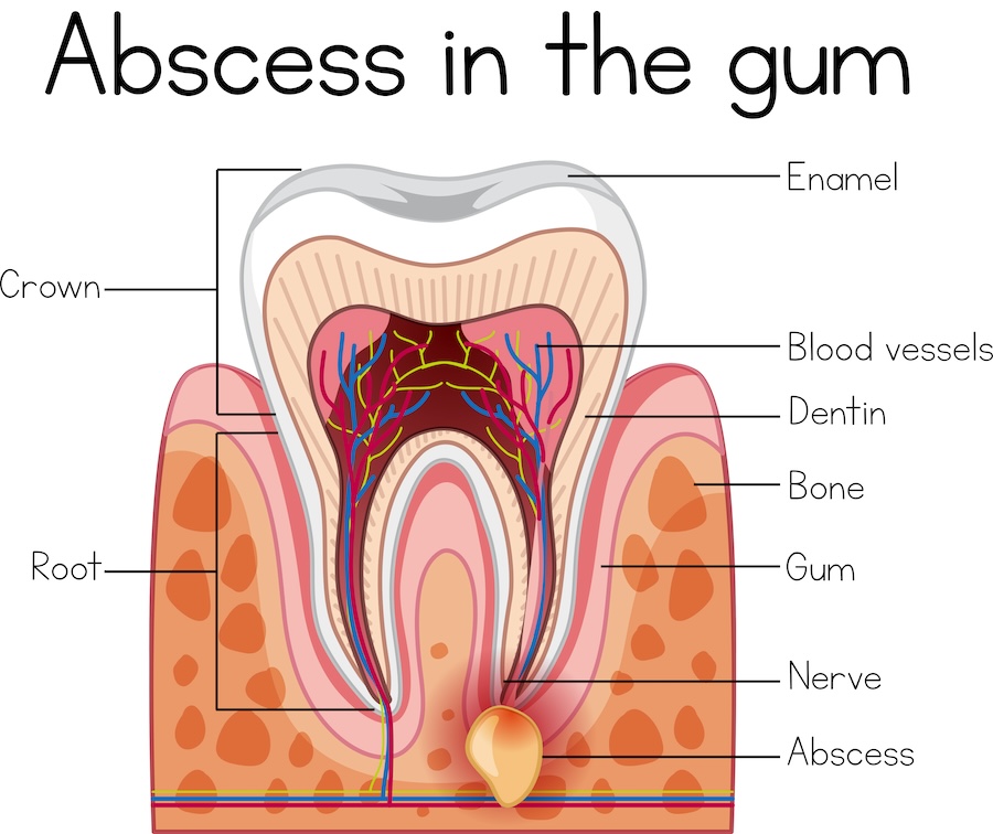 abscessed tooth, tooth pain, dentist in Mililani, root canal therapy, tooth extraction, dental infection, Mauka Family Dental, gum abscess