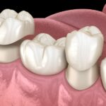 dental crown replacement, dental crown signs, crown damage, dental restoration, Mauka Family Dental, Mililani HI, crown lifespan, crown evaluation, dental crown, dental crown Mililani, dentist Mililani