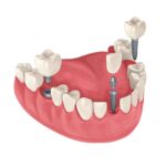 dental implant for missing tooth, dental implants for missing teeth