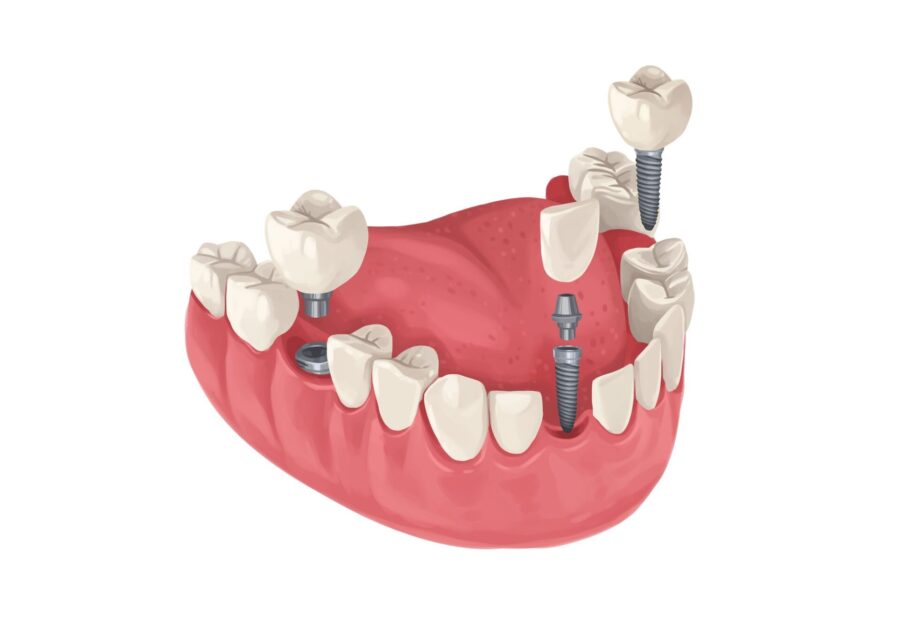 dental implant for missing tooth, dental implants for missing teeth