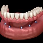 implant supported dentures