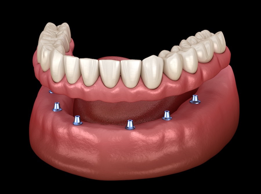 implant supported dentures