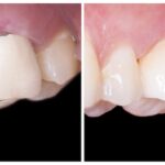 dark margin around aging metal ceramic dental crown