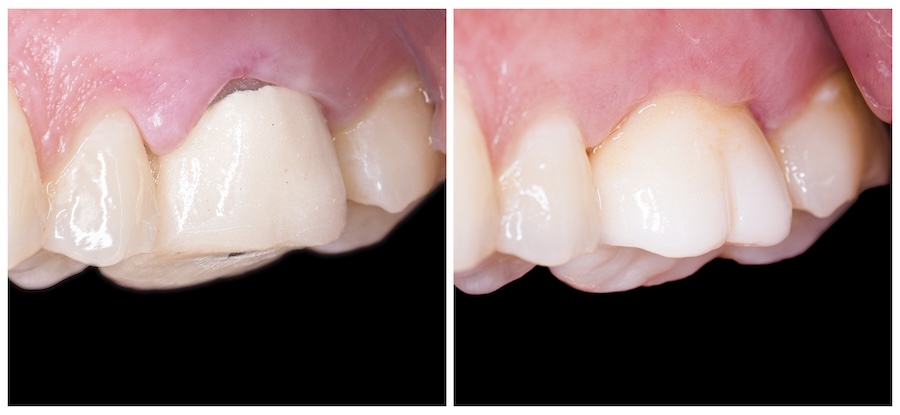 dark margin around aging metal ceramic dental crown