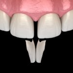 cosmetic dental bonding on a gap in the front teeth