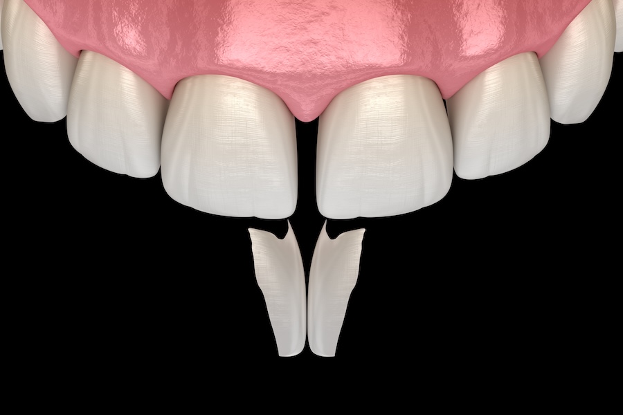 cosmetic dental bonding on a gap in the front teeth